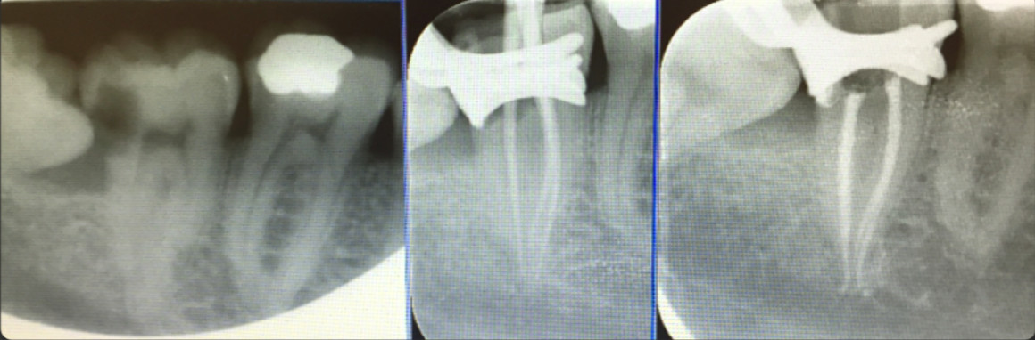 Endodoncia-recortada