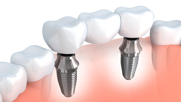 Imagen-4.-Puente-dental-sobre-implantes