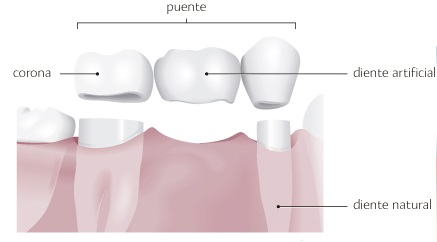 Imagen-5.-Puente-dental-sobre-dientes-naturales-con-previo-tallado-de-los-mismos
